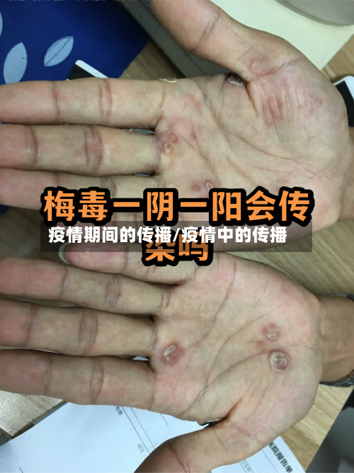 疫情期间的传播/疫情中的传播
